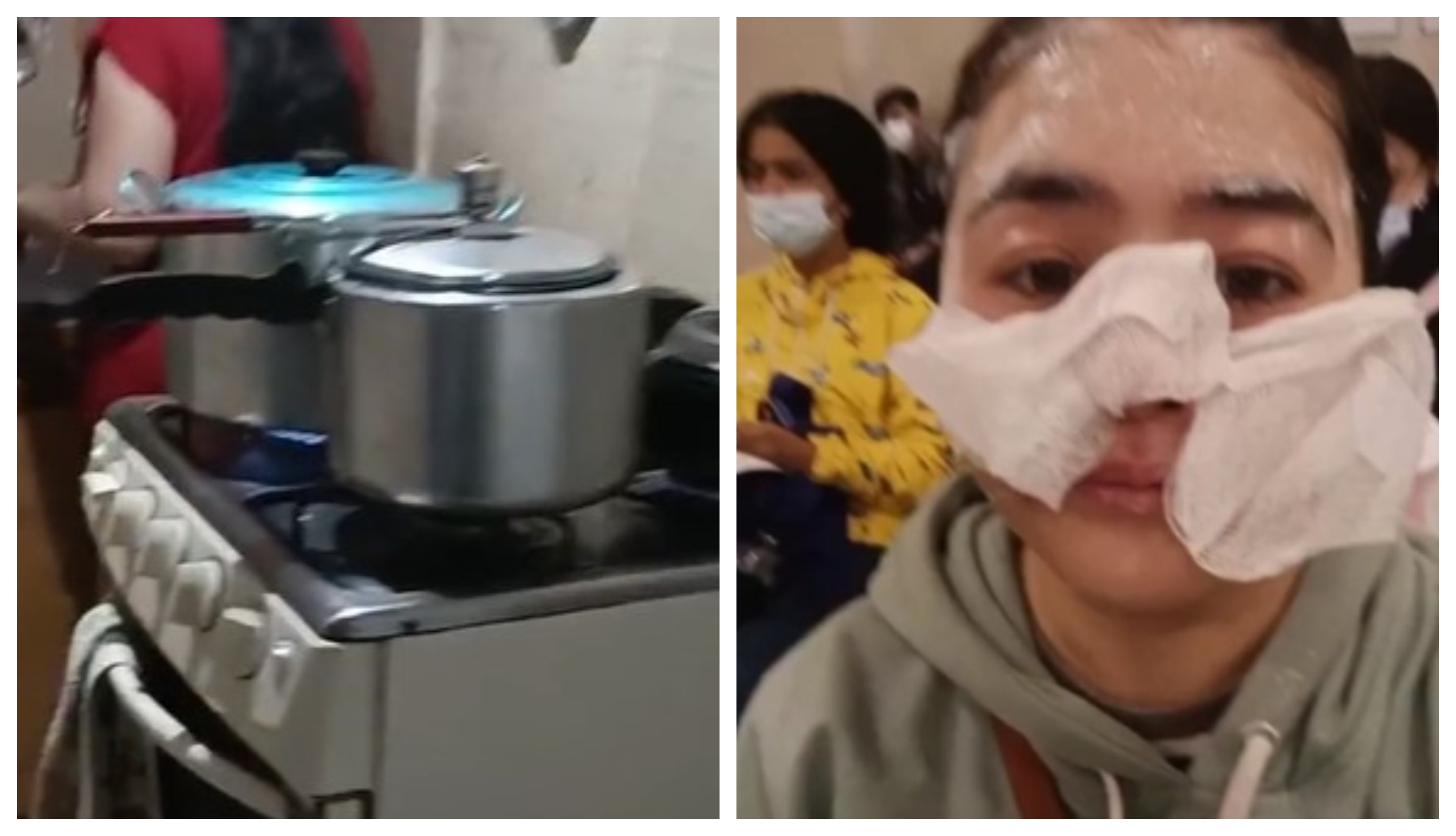 Mujer se quemó la cara por el estallido de una olla a presión