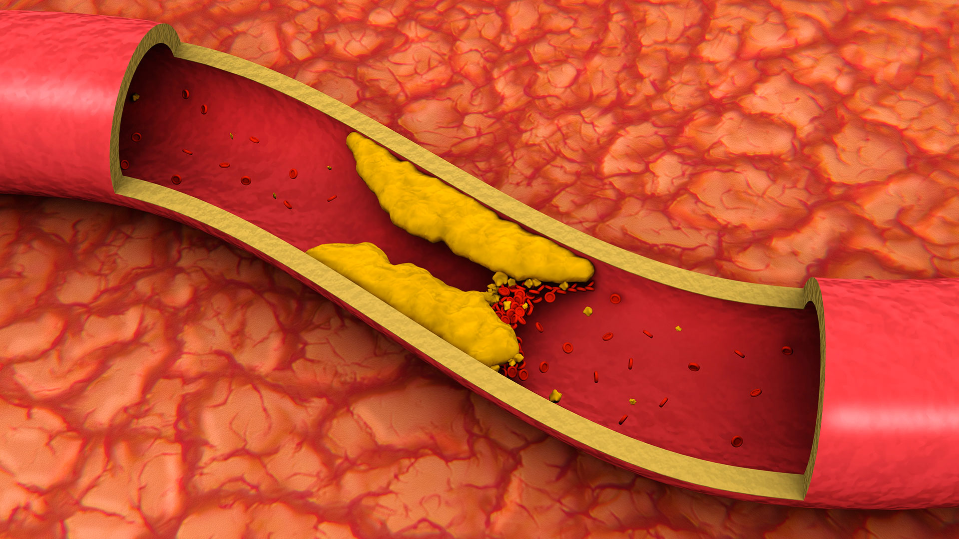 El colesterol alto en la sangre puede acumularse en las paredes de las arterias y formar depósitos conocidos como placas de ateroma. Con el tiempo, estas placas pueden endurecerse y estrechar las arterias, lo que puede obstaculizar el flujo de sangre y aumentar el riesgo de enfermedades cardíacas y derrames cerebrales.(Gettyimages)
