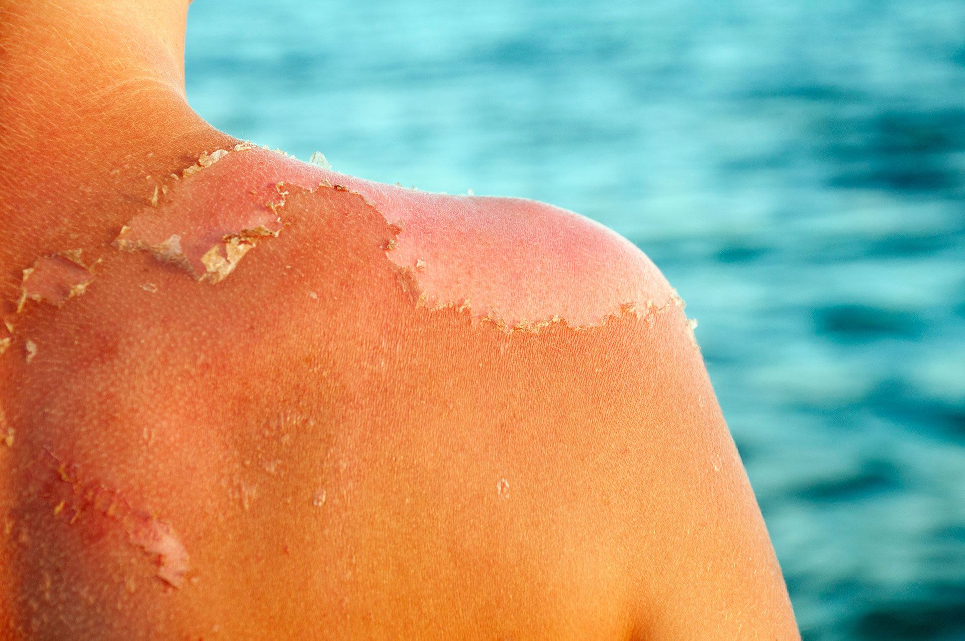 Sol y bronceado: cuáles son las cuatro claves para evitar que la piel se pele