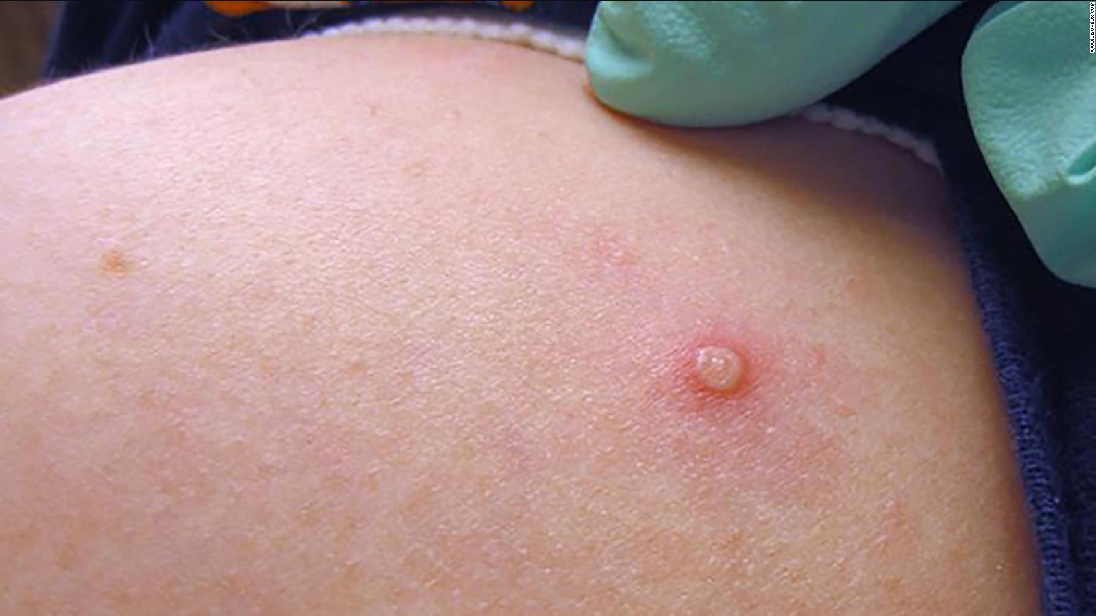Este tipo de lesiones en la piel son los síntomas más frecuentes de la viruela símica en 2022. Pueden aparecer en zonas genitales, manos, brazos y piernas