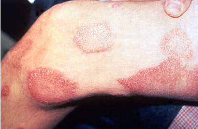 Las manchas en la piel que persisten y tienen adormecimiento pueden ser síntomas de lepra/Archivo