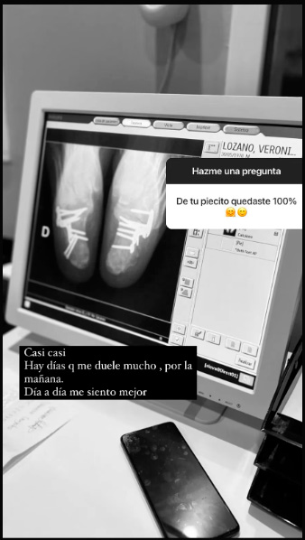 Verónica Lozano mostró una radiografía de sus pies tras haber sido operada (Instagram)