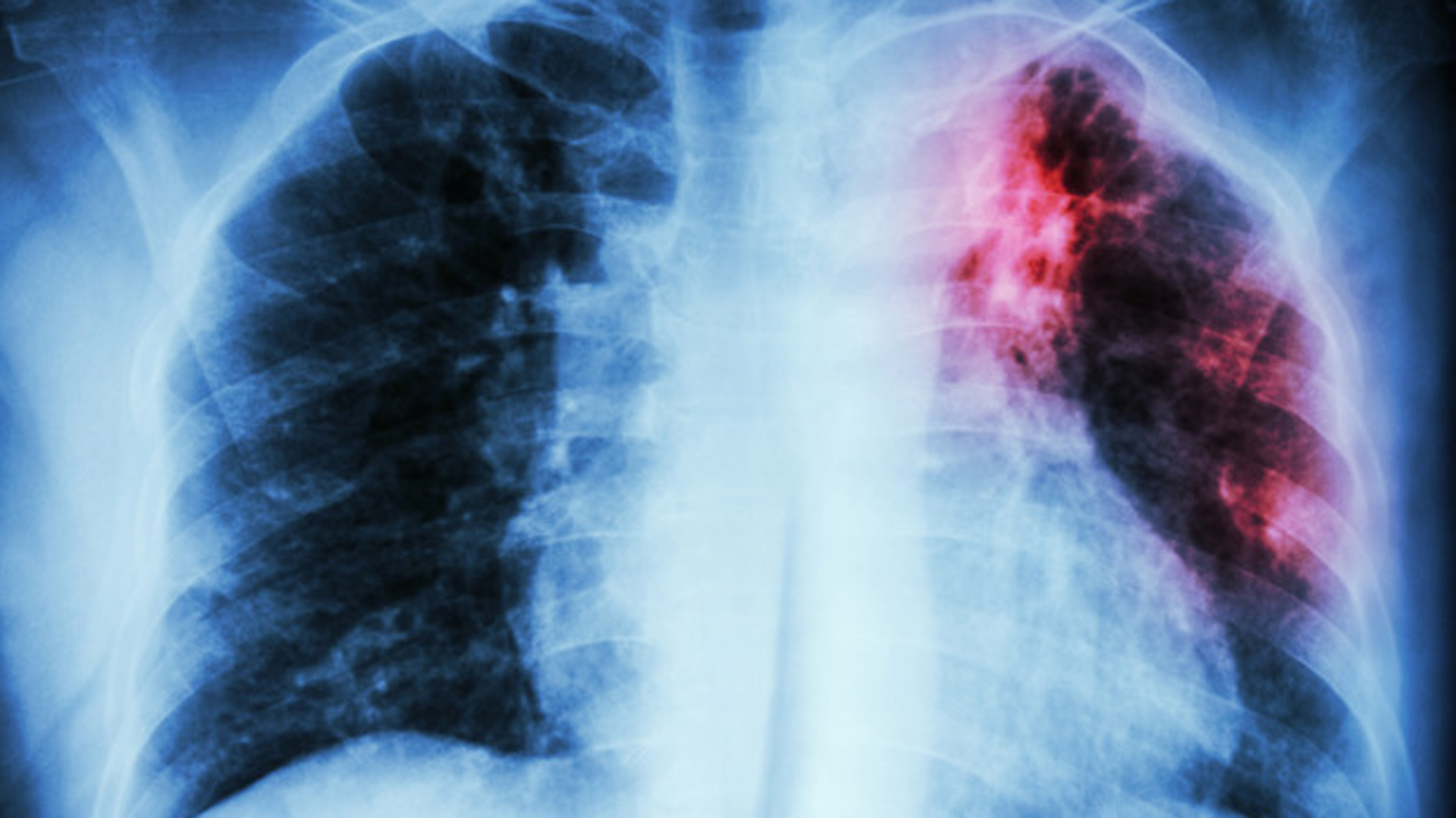 Ipf Causes Scarring Of The Lung Tissue, Making It Thick And Hard/(Istock)