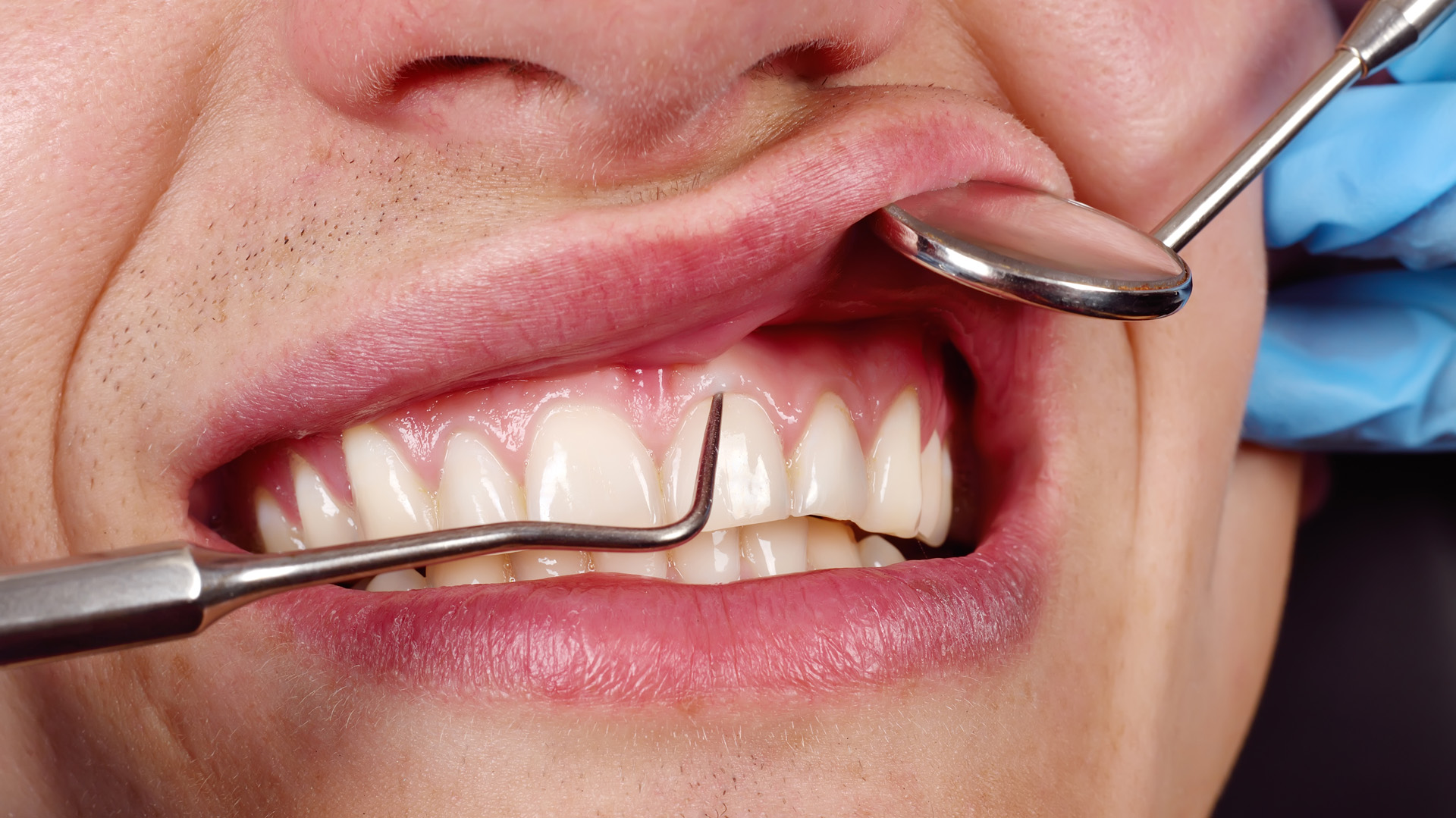 El uso de hilo dental previene problemas en las caries. Uno de ellos puede ser la gingivitis
