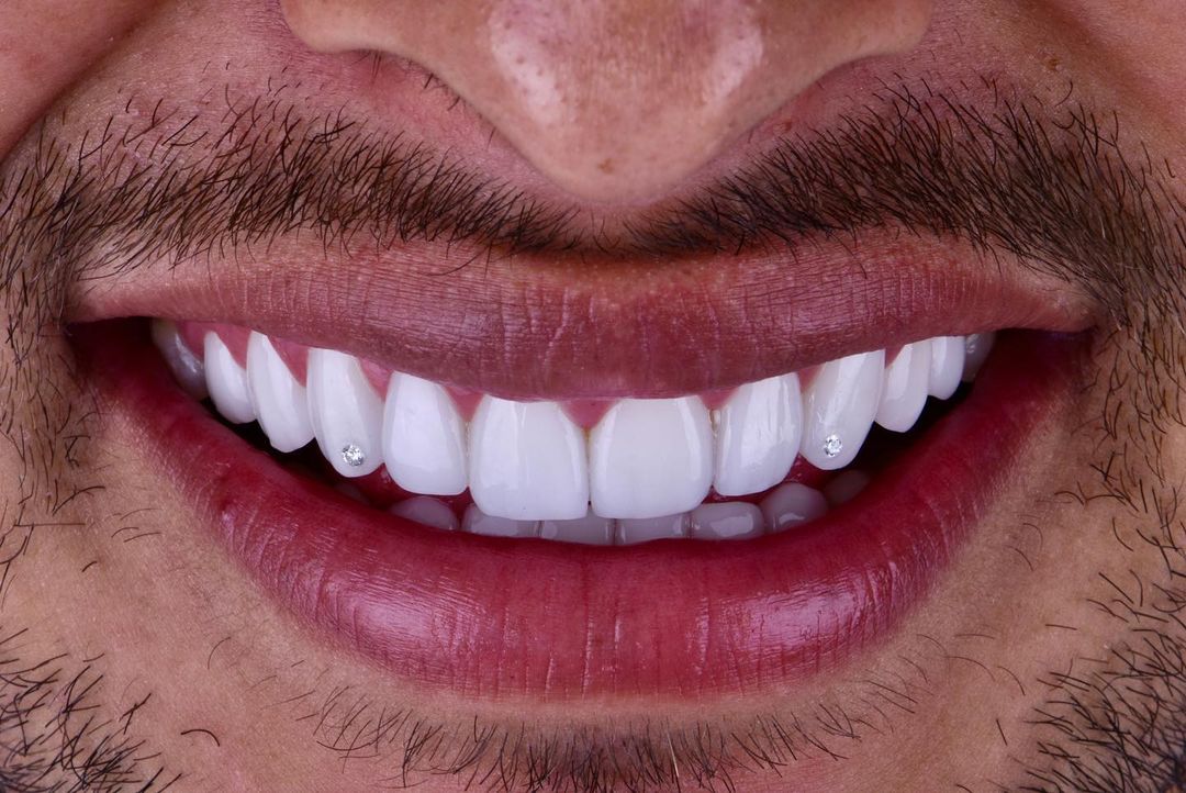 Cuánto cuesta incrustación de diamantes en los dientes las que hizo Alexis Vega - Infobae