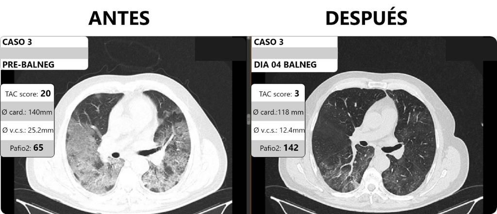 Cambio de paradigma en la terapia intensiva por COVID: un innovador tratamiento argentino mostró una reducción drástica de la mortalidad 