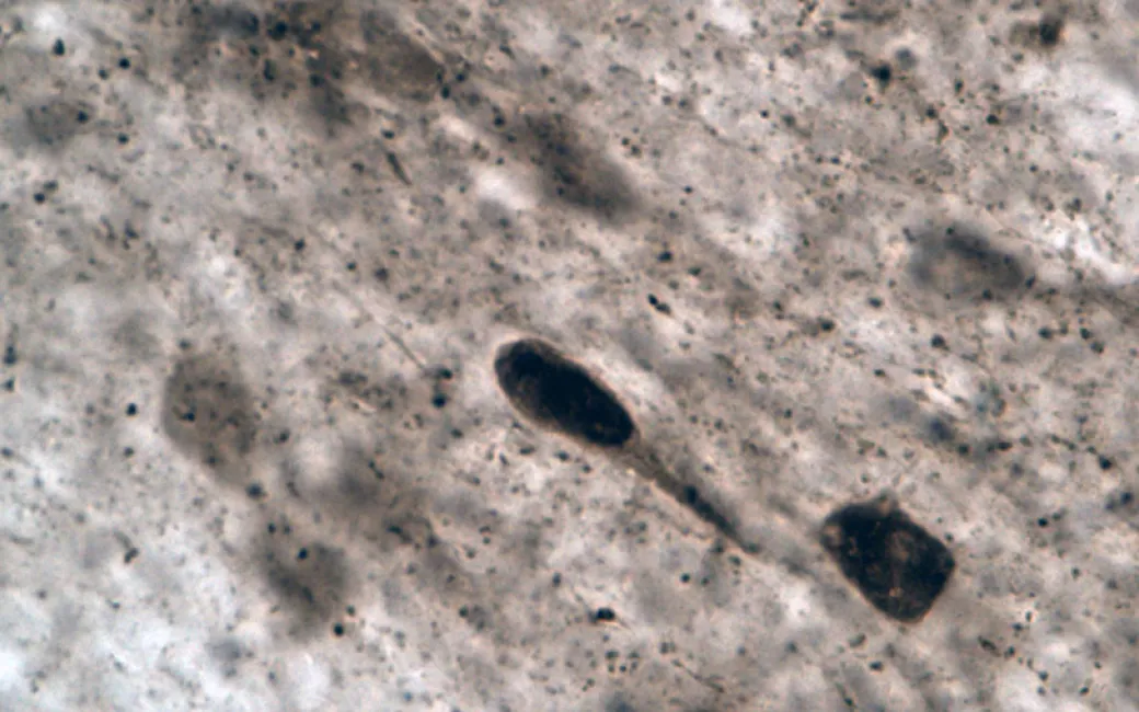 Una imagen de la agregación de alfa-sinucleína en una célula nerviosa, del estudio realizado por científicos de Finlandia e Italia (Timo Myöhänen)