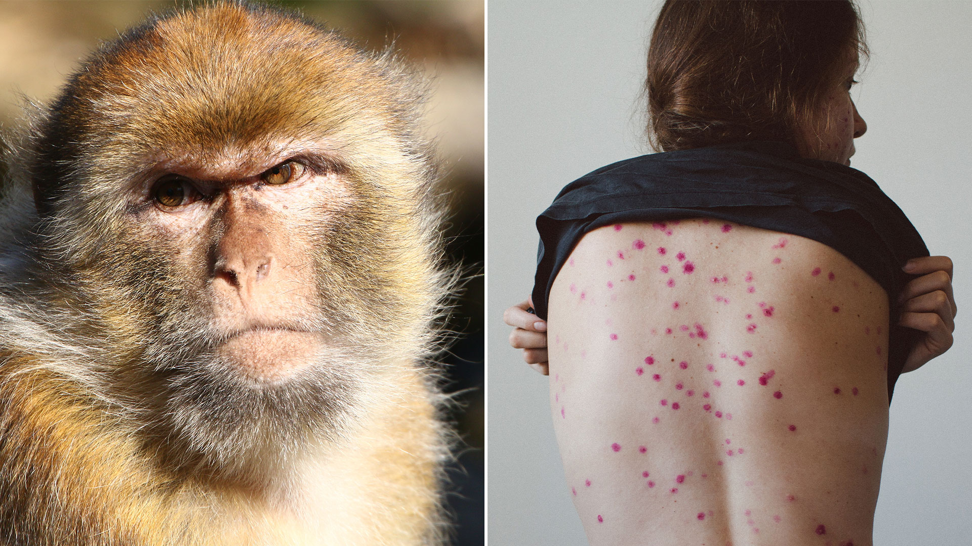 Cómo se contagia la viruela del mono en los humanos y cuáles son sus síntomas