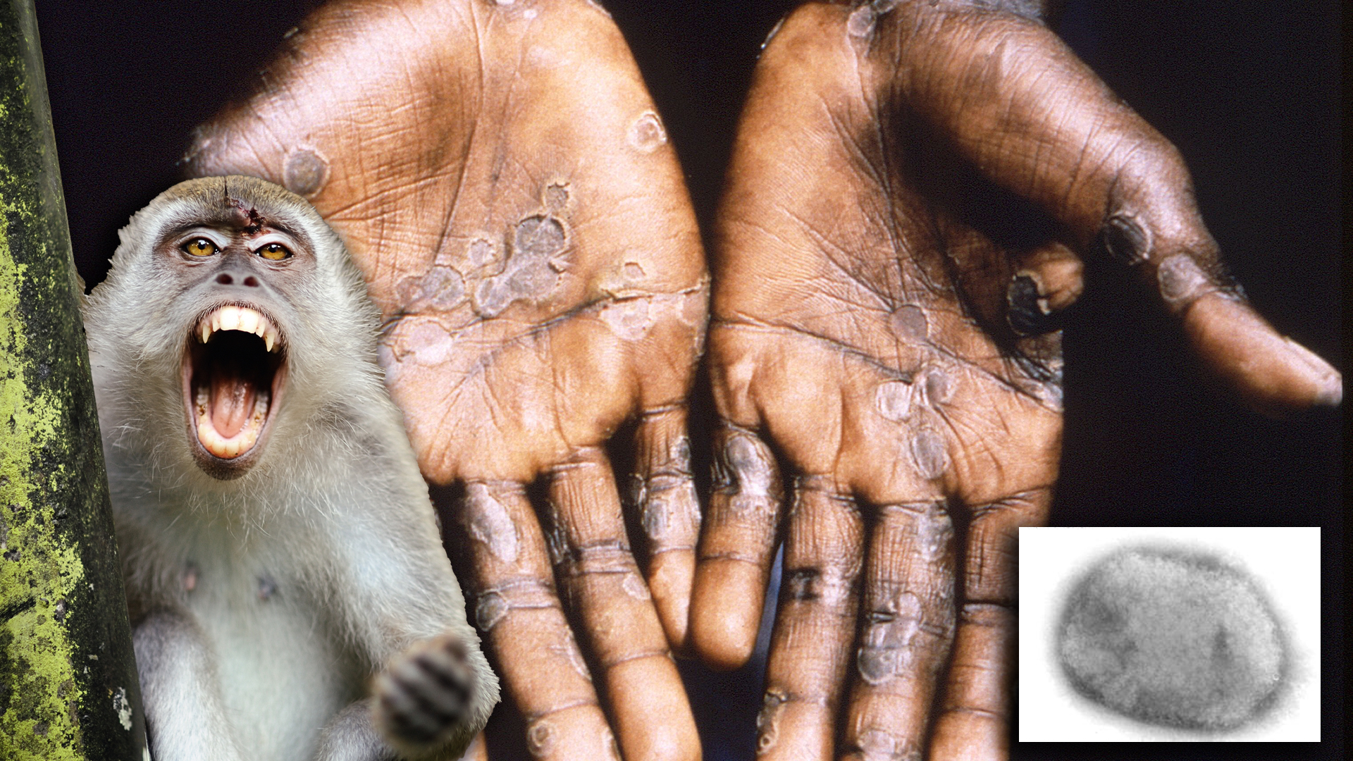 La viruela del mono, una infección zoonótica rara emergente, potencialmente mortal, que puede propagarse a los humanos y tienen su origen en África occidental y central, donde ahora es endémica