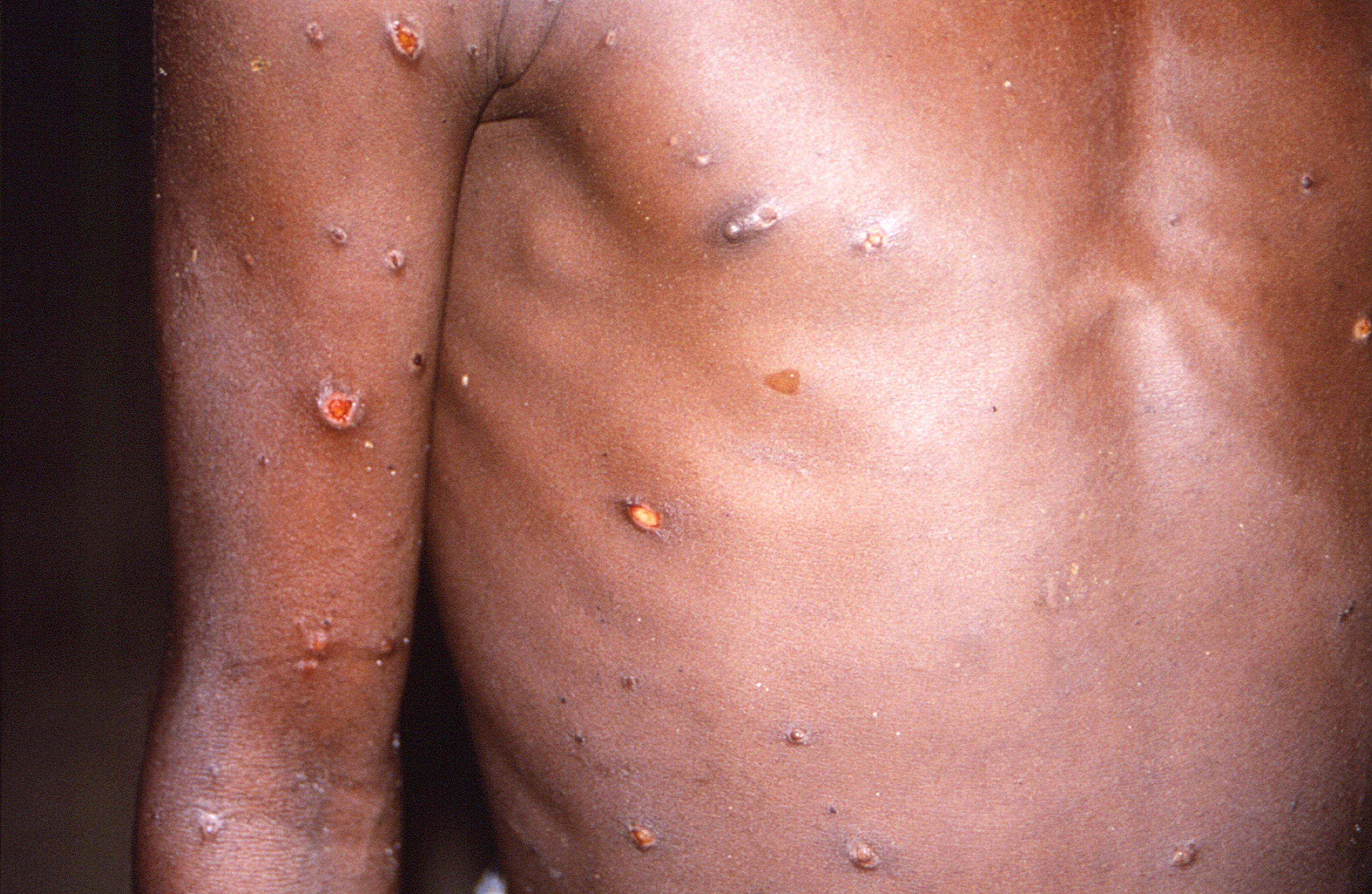 A CDC image shows skin lesions on a monkeypox patient