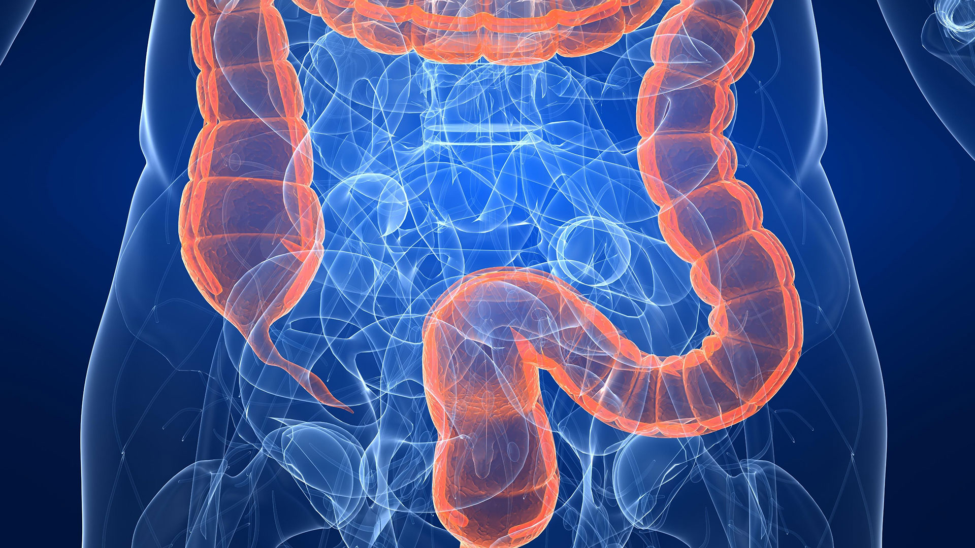 Día Mundial del Cáncer de Colon: la importancia de reforzar los controles ante el crecimiento de casos en menores de 50 - Infobae