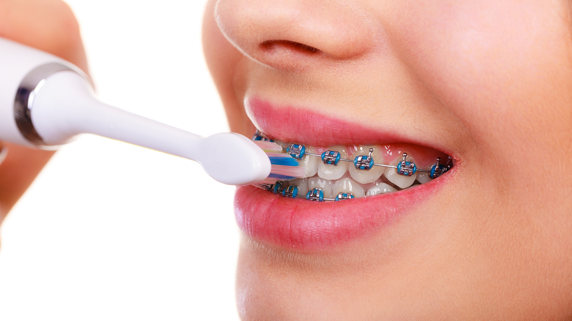 Las personas con ortodoncia deben cambiar el hilo dental por los cepillos interdentales / (Getty)