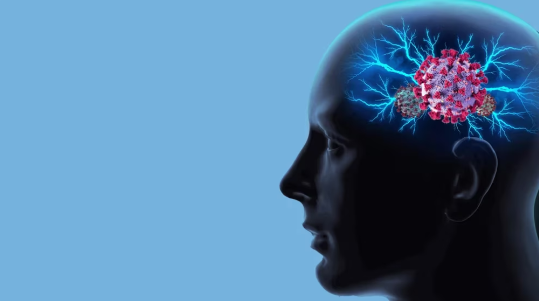 Científicos encontraron que el covid-19 puede penetrar el cerebro causando daño neurológico de larga duración. Shutterstock