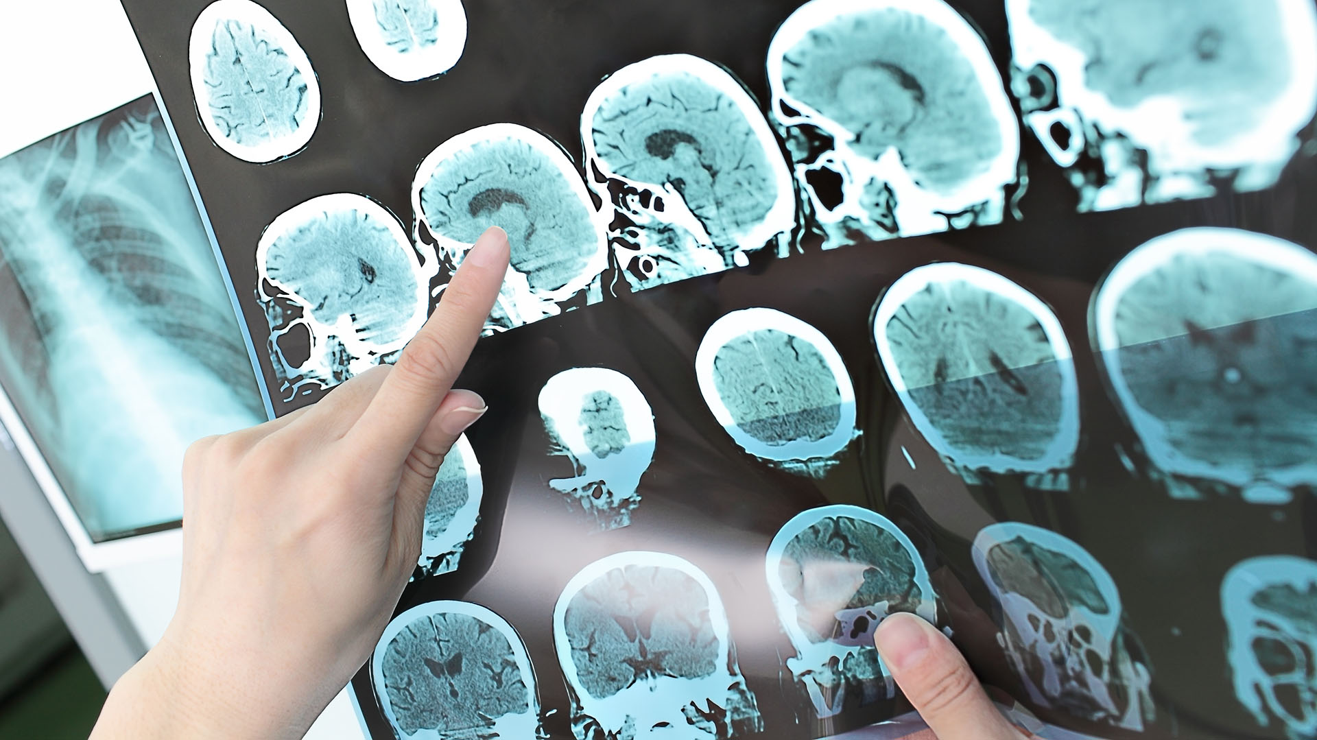 Generalmente se presenta con brotes que pueden afectar a cualquier área del cerebro (Getty Images)
