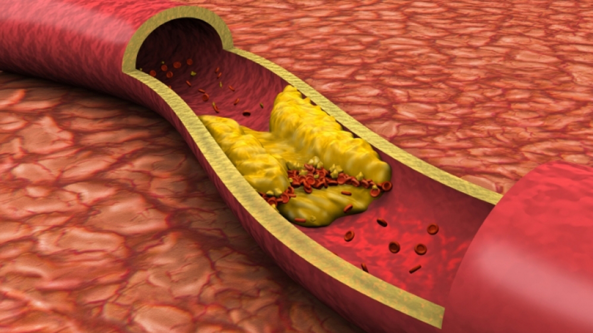 The accumulation of cholesterol plaques in the arteries can cause a blockage and subsequent heart attack