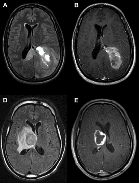 Gliomas: resonancias magnéticas con lesiones que impresionan glioblastomas
Crédito: Gentileza neurocirujano Franco Rubino