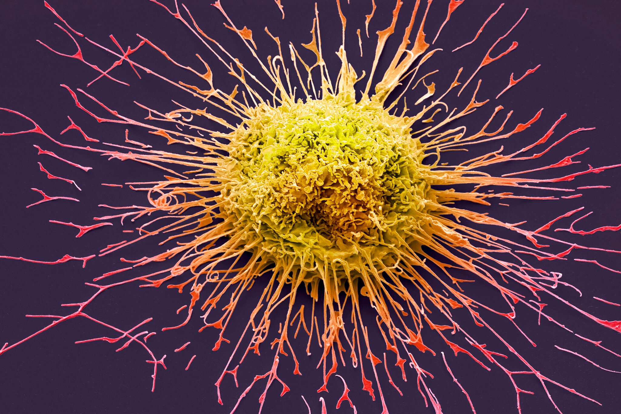 Micrografía en color de una célula de un tipo común de cáncer de pulmón, llamado cáncer de células no pequeñas. Un nuevo fármaco se dirige a la proteína mutada que provoca el crecimiento incontrolado (Steve Gschmeissner/Science Source)