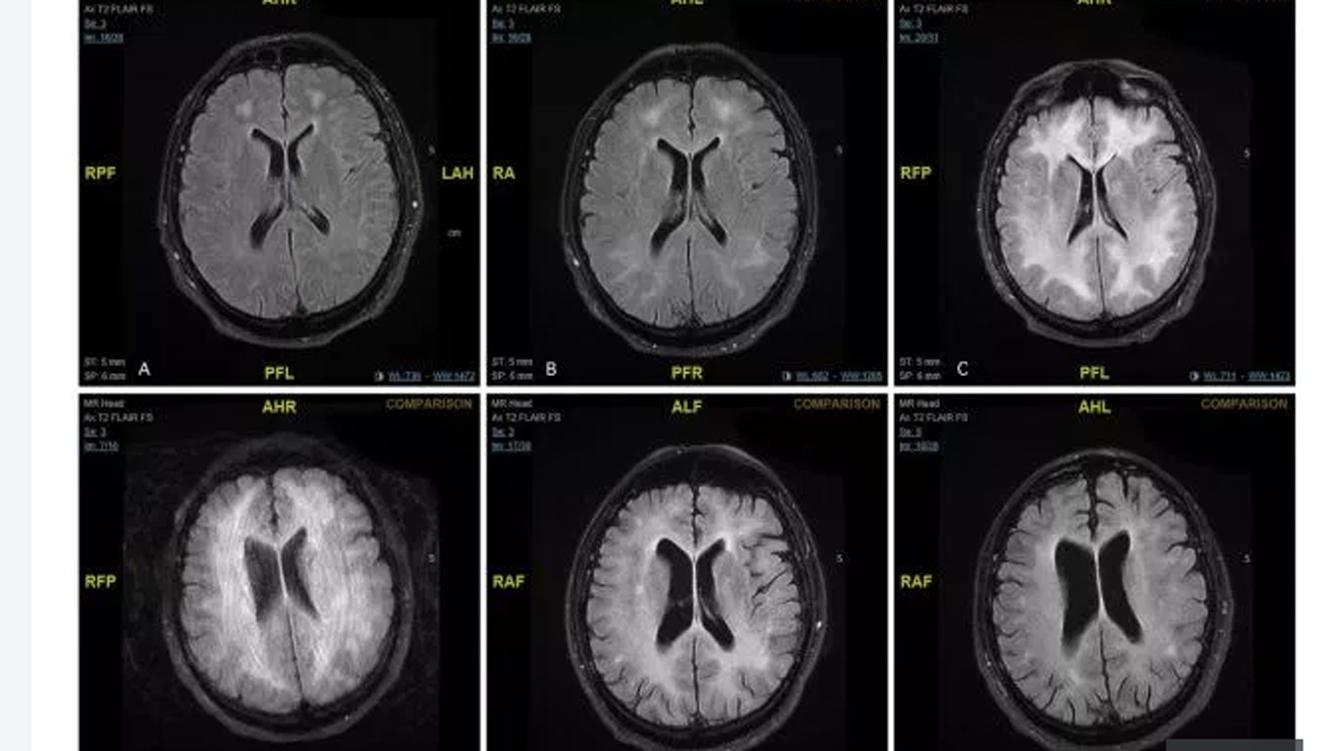 La droga actúa como “exprimiendo” neuronas para que liberen estas sustancias, facilitando euforia, sensaciones de poder (Gentileza The Sun)