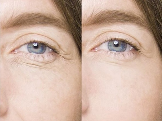 Las bolsas en los ojos son un problema común que regularmente no afectan la salud de las personas (Europa Press)