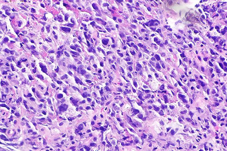 El linfoma de Hodgkin es un tipo de cáncer que se da en las células del cuerpo (Foto: CancerQuest)