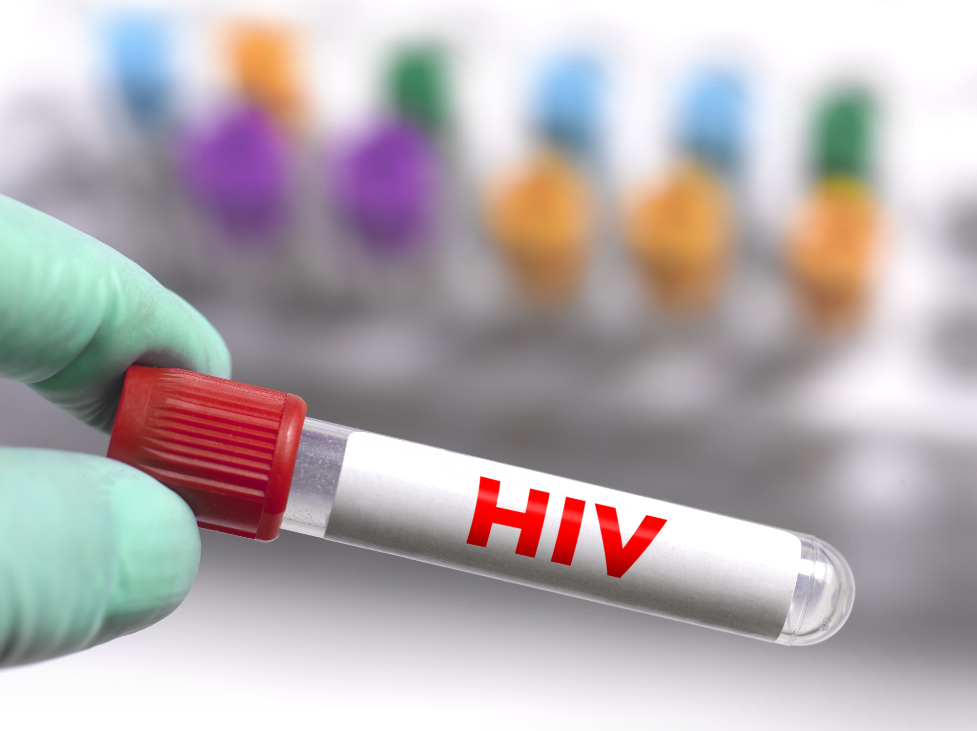 Avance hacia la cura del VIH: un tercer paciente logró controlar al virus tras un trasplante de médula 