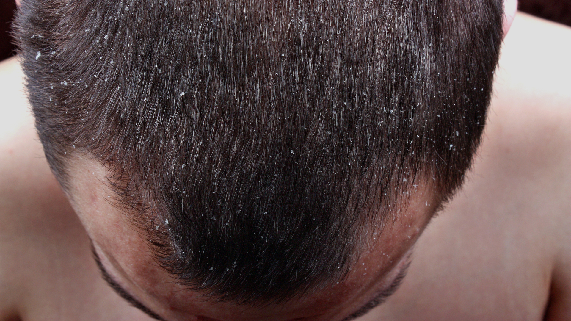 If the dandruff persists, it is best to consult a doctor.  (Stock)
