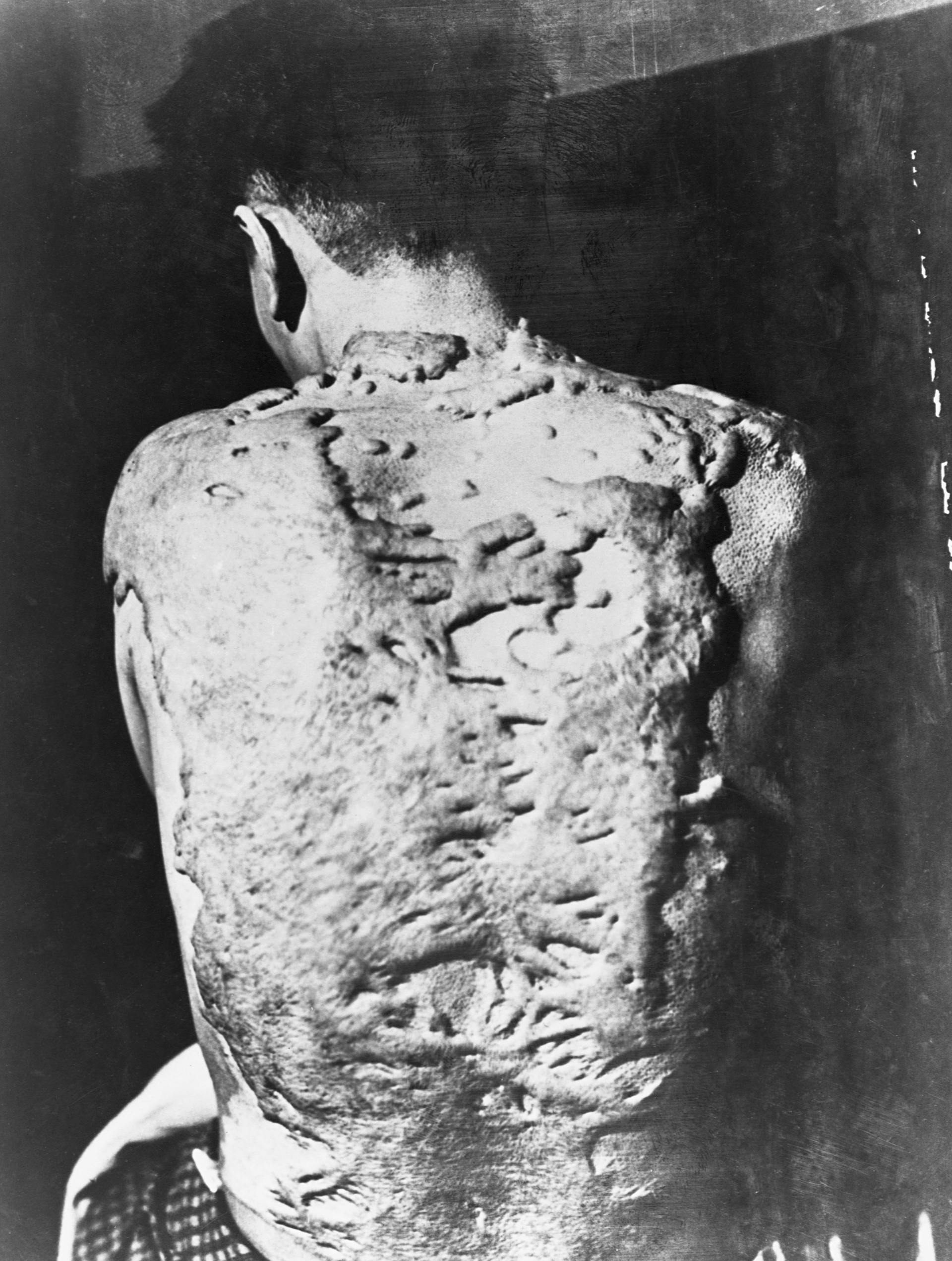 Las impactantes quemaduras en la espalda de un sobreviviente de la bomba atómica de Nagasaki. Los queloides -crecimientos densos y fibrosos que crecen sobre el tejido cicatricial- cubren todo su cuerpo (Corbis vía Getty Images)
