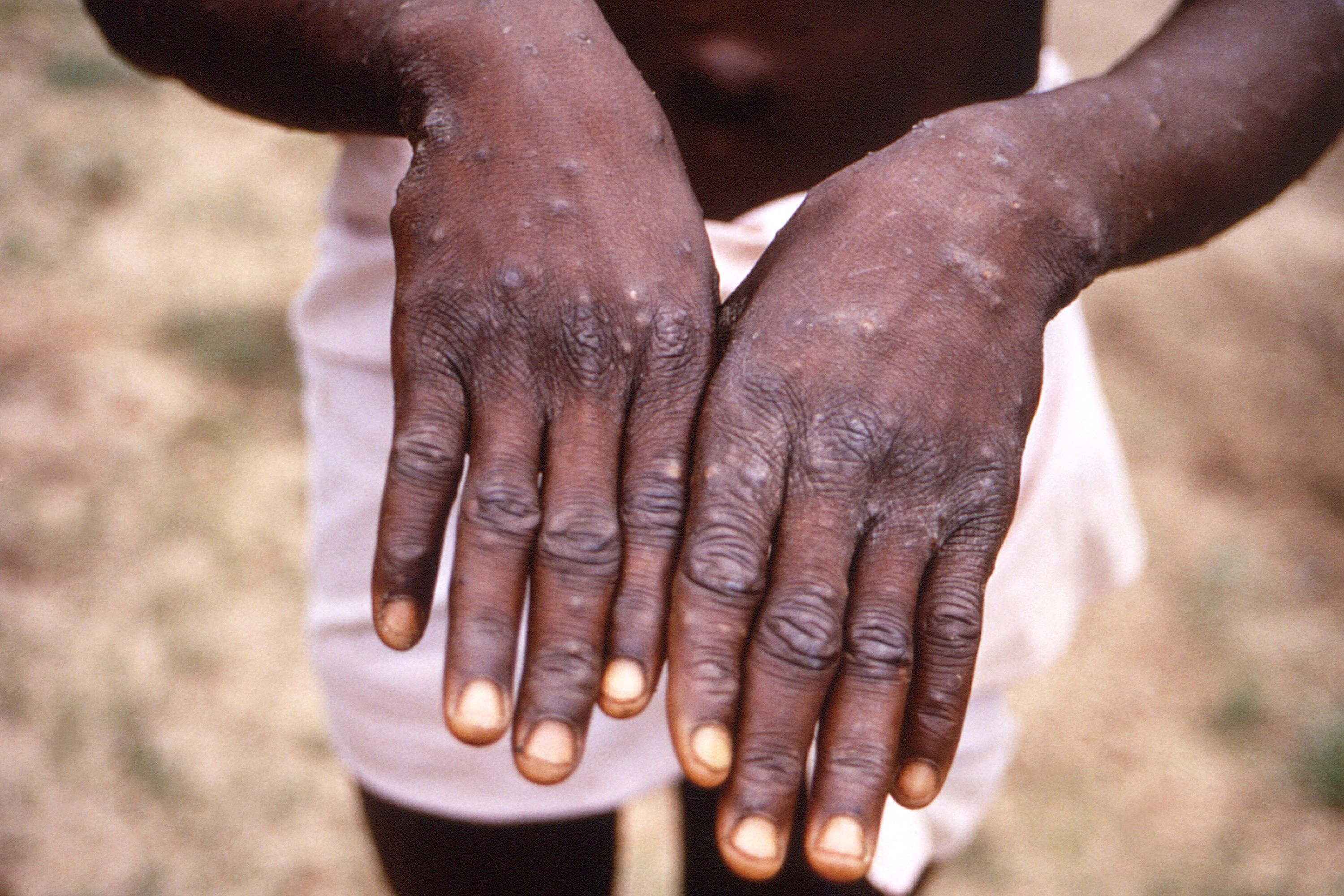 FILE PHOTO: A CDC image shows a rash on a monkeypox patient
