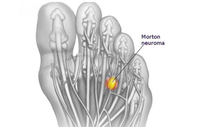 El neuroma de Morton se trata de un engrosamiento del tejido que rodea un nervio que conduce a los dedos del pie 