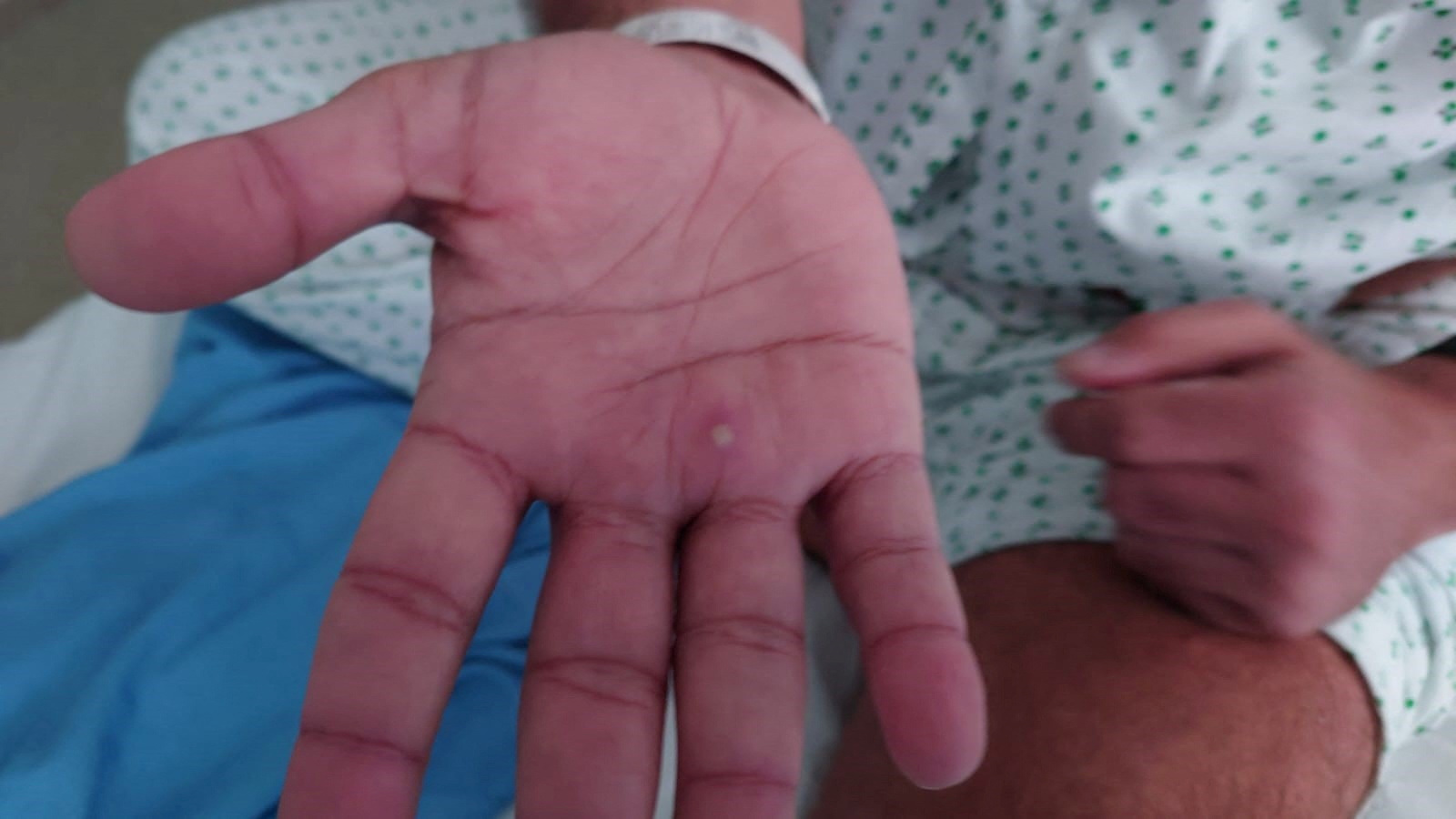Las ulceraciones en la piel son uno de los principales síntomas de la viruela del mono