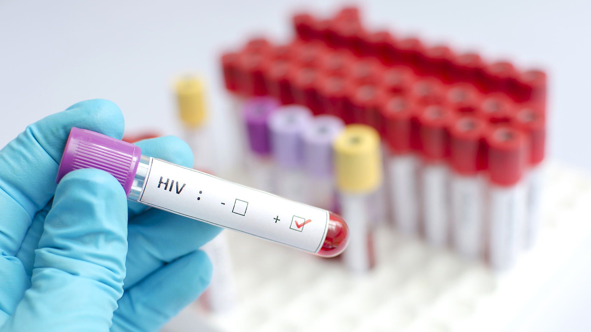 Tras la supresión del tratamiento antirretroviral, la paciente tiene un control absoluto de la replicación del VIH, con carga viral indetectable y sin tomar fármacos contra el virus (Getty)