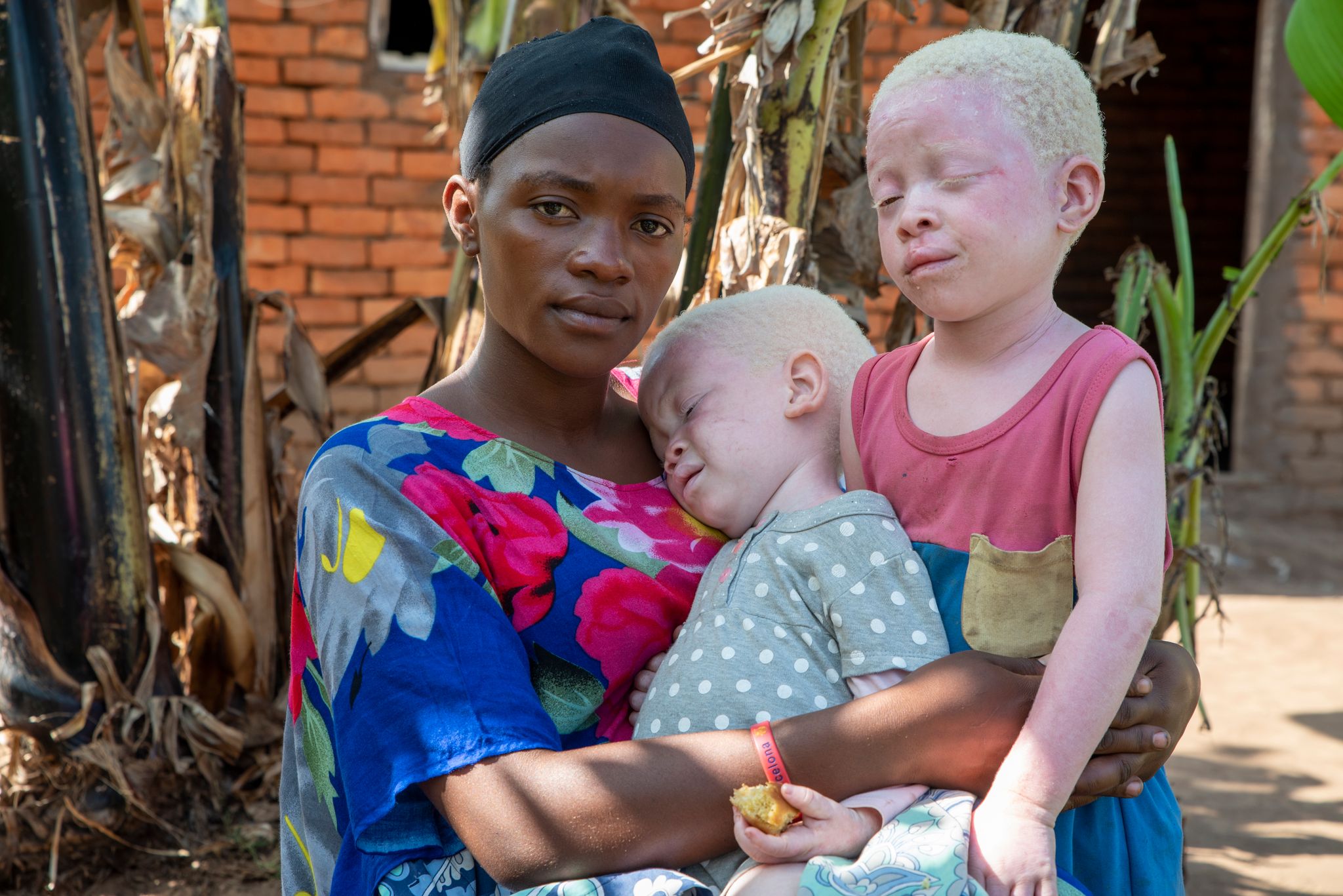 El albinismo no tiene cura, pero existen varios tratamientos para mejorar la calidad de vida de los pacientes (Tobias Pflanz/Christoffel Blinde)