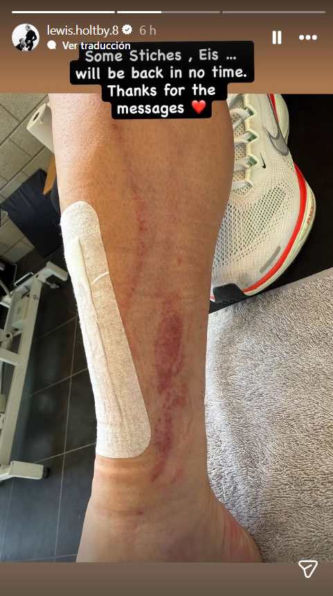 La impresionante lesi&oacute;n en el f&uacute;tbol europeo que abri&oacute; el debate sobre el uso de las canilleras