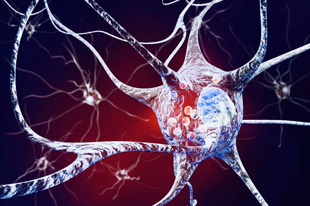 El exceso de depósitos de la proteína alfa-sinucleína, conocidos como cuerpos de Lewy, se acumulan dentro de las neuronas, causando daño a ciertas partes del cerebro y, como resultado, una disminución en la cognición y el movimiento 