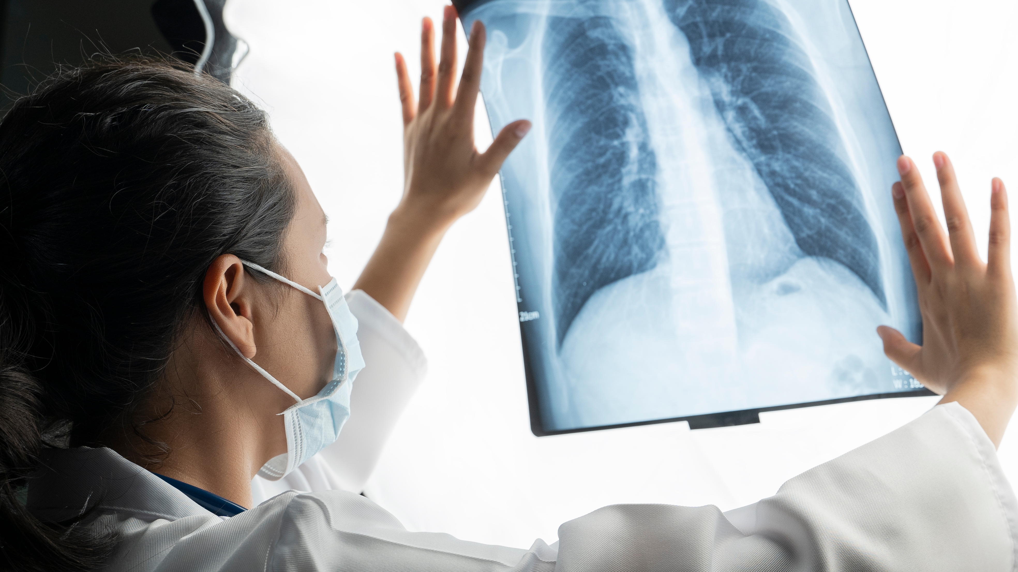 Una simple prueba de orina podría detectar el cáncer de pulmón en etapas tempranas
