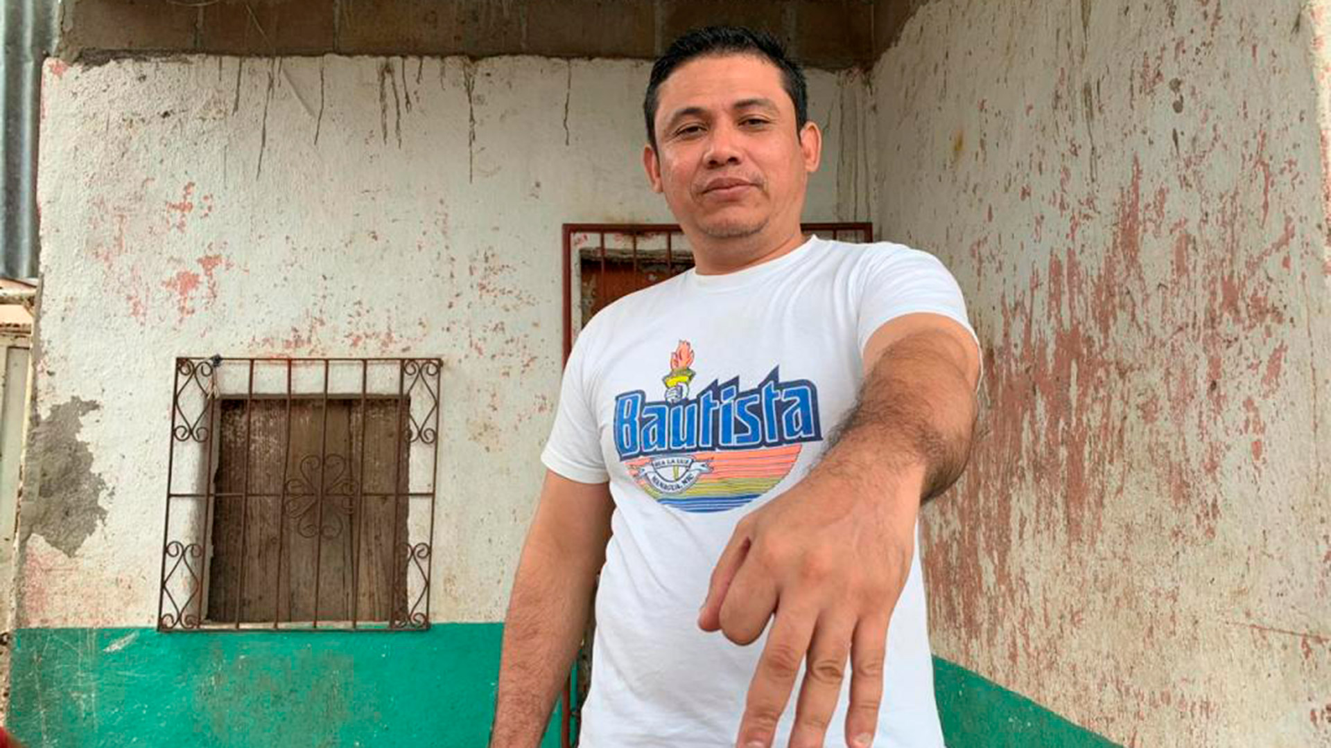 Lenin Rojas Contreras, detenido en julio de 2018 , muestra sus dedos con las uñas arrancadas durante las torturas que sufrió a manos de policías y paramilitares