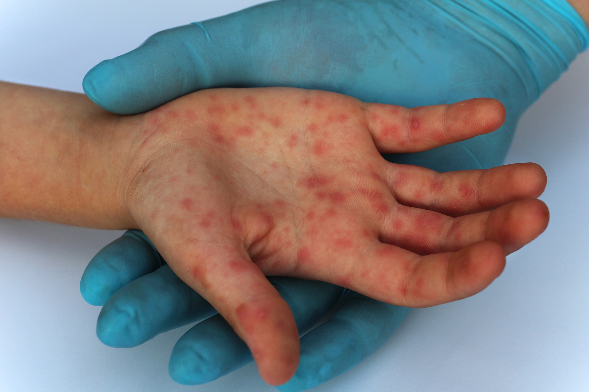 La lucha contra el coronavirus suspendió las campañas de combate contra el sarampión en todo el mundo (Shutterstock)