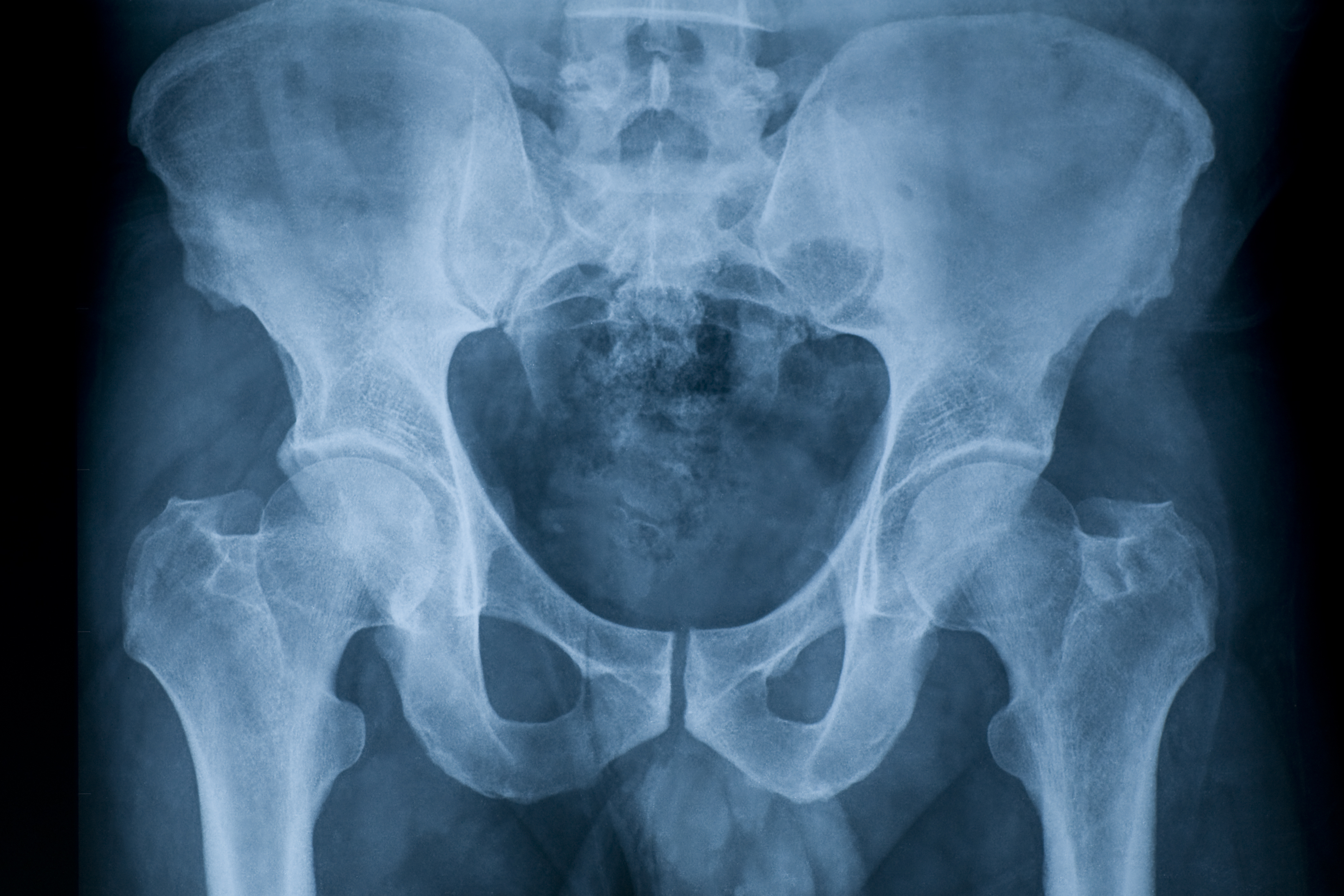 Según los especialistas, en Argentina se producen cotidianamente 90 fracturas de cadera por osteoporosis