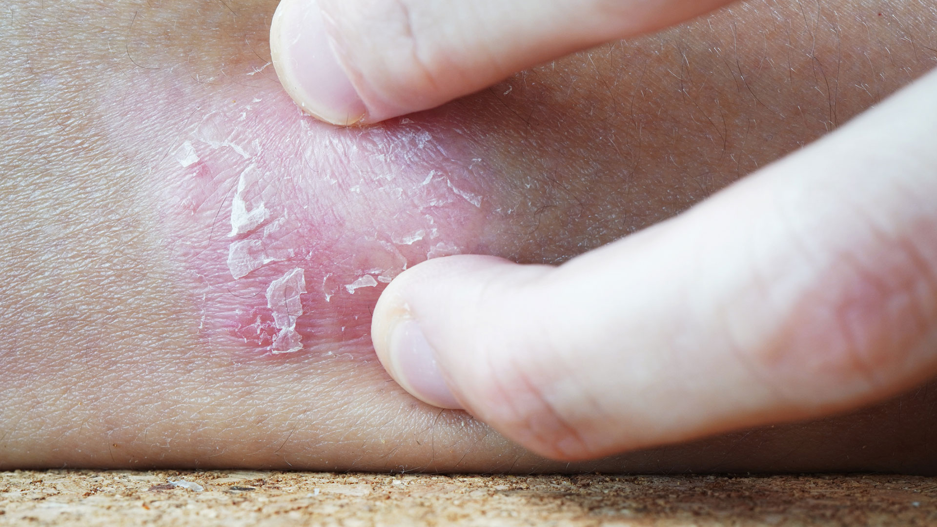 La psoriasis se manifiesta en lesiones rojas cubiertas por escamas blancas y secas que se localizan con mayor frecuencia en los codos, las rodillas, el tronco y el cuero cabelludo (Gettyimages)