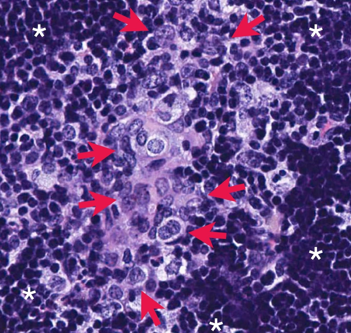Las flechas rojas indican las células cancerosas de la próstata que han hecho metástasis en los ganglios linfáticos de un ratón genéticamente modificado. Este proceso se bloquea en ratones que carecen de la enzima PHLPP2-SALUD NOWAK ET AL
