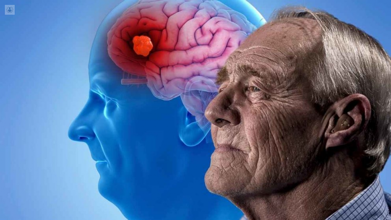 Enfermedad de Alzheimer. (foto: Top Doctors)