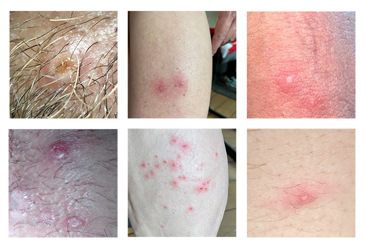 Algunas de las lesiones en la piel, en diferentes partes del cuerpo, que han tenido pacientes en Bélgica como síntomas. Allí también se encontraron casos asintomáticos/Instituto de Medicina Tropical de Bélgica
