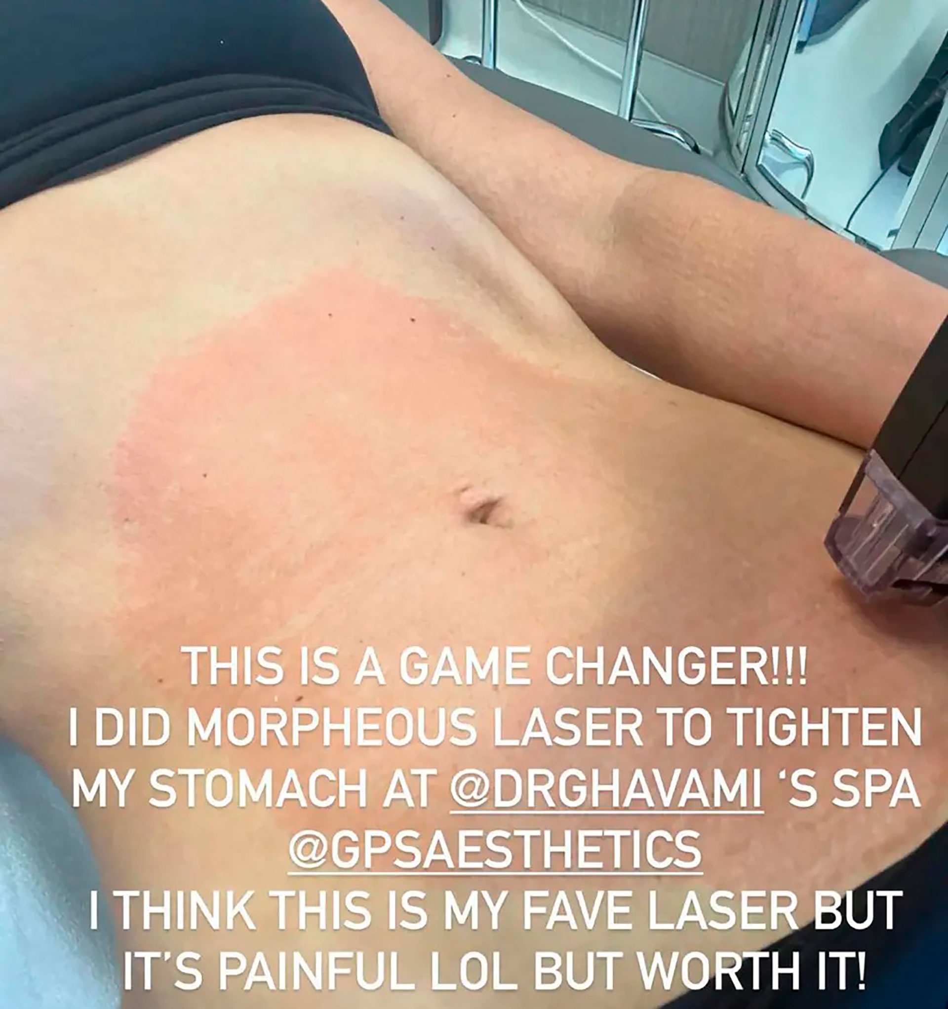 Kardashian se sometió a un tratamiento con láser para tensar la piel de su estómago