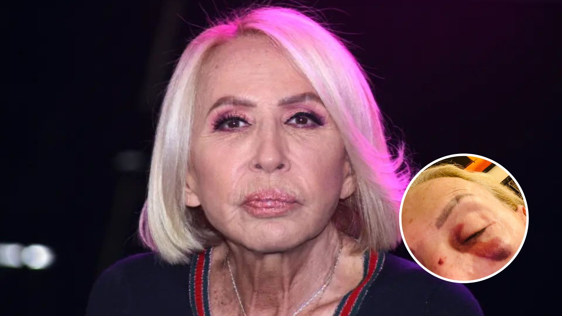 Laura Bozzo appeared with bruises on her face after suffering an anxiety attack