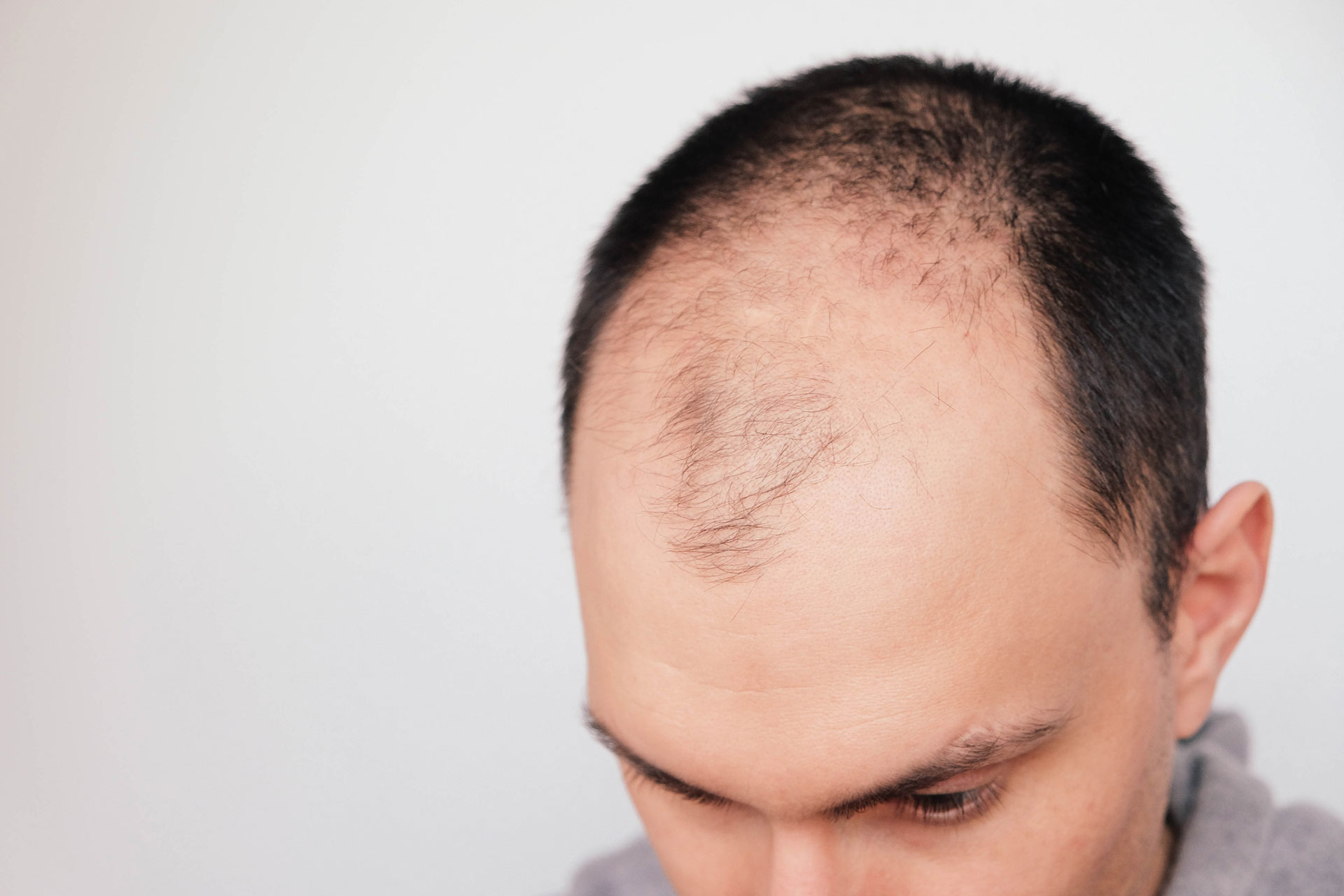 La alopecia androgénica en los hombres es también conocida como calvicie de patrón masculino