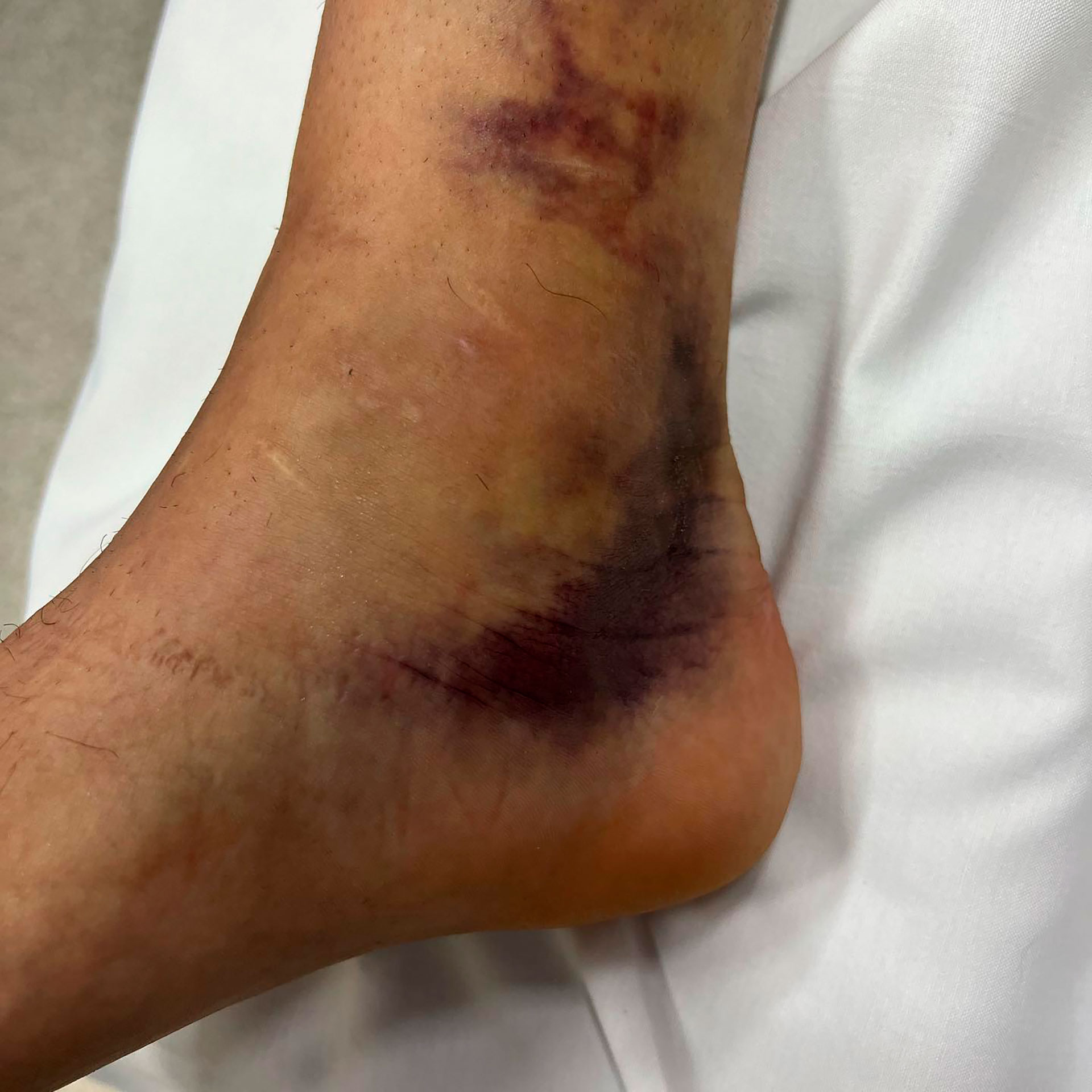 This is how Zebalos' ankle turned out