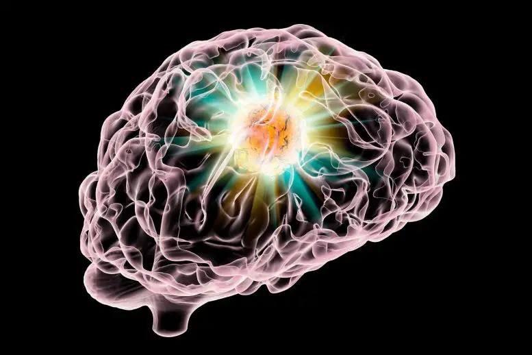 Se encontró que los vasos sanguíneos que alimentan los tumores cerebrales de glioma de alto grado contienen altos niveles de receptores de lipoproteínas de baja densidad/Archivo