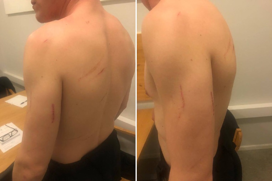 El abogado de Andréi Medvédev compartió fotos de las heridas sufridas al pasar las cercas con púas en la frontera