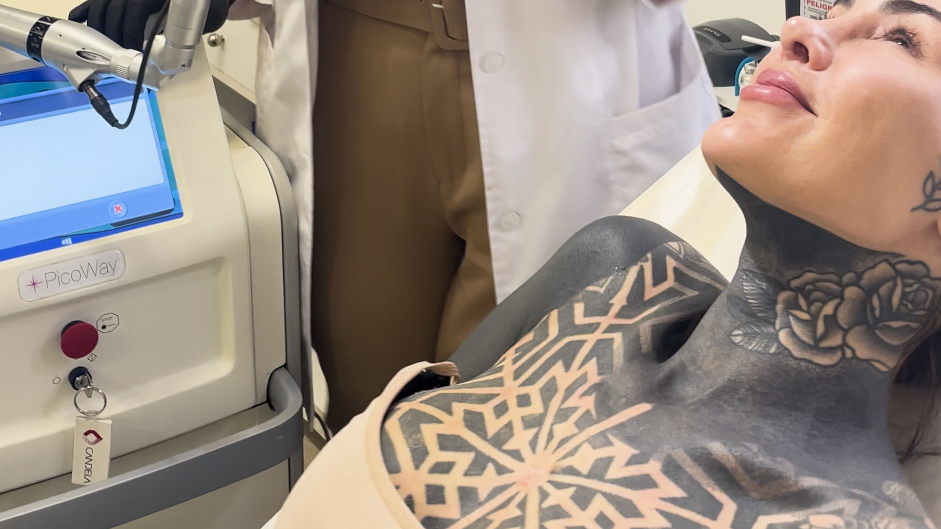Qué tecnología se utilizó para borrar el tatuaje del tórax de Cande Tinelli, visto por los expertos