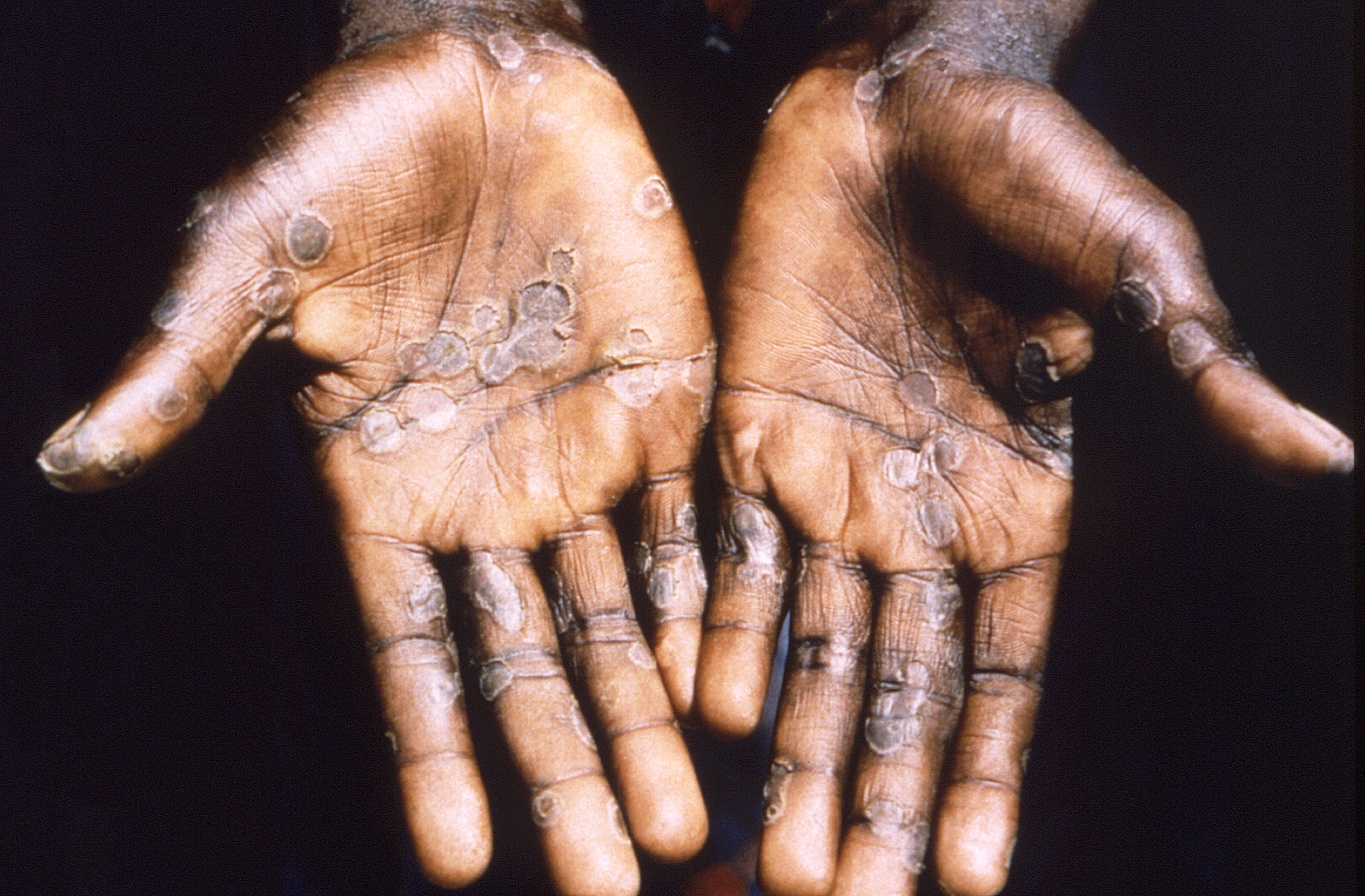 Close-up of a patient's hands, on black background, showing lesions from the monkeypox virus, the Democratic Republic of the Congo, 1997. Courtesy CDC / Mahey et al.  (Photo via Smith Collection / Gado / Getty Images)